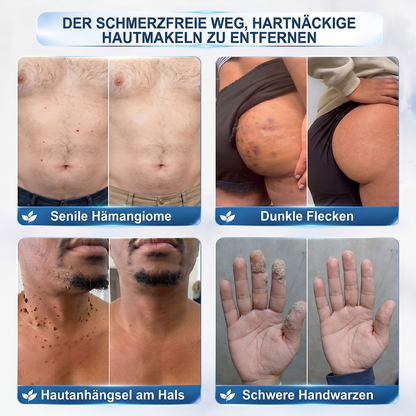𝐇𝐈𝐒𝐊𝐈𝐍®👩‍⚕️⭐ 7-Tage-Hautmakel- & Hautanhängsel-Entferner Schmerzfreier Rollerball-Stift zur schonenden Entfernung von Hautanhängseln und Hautflecken – narbenfrei💚