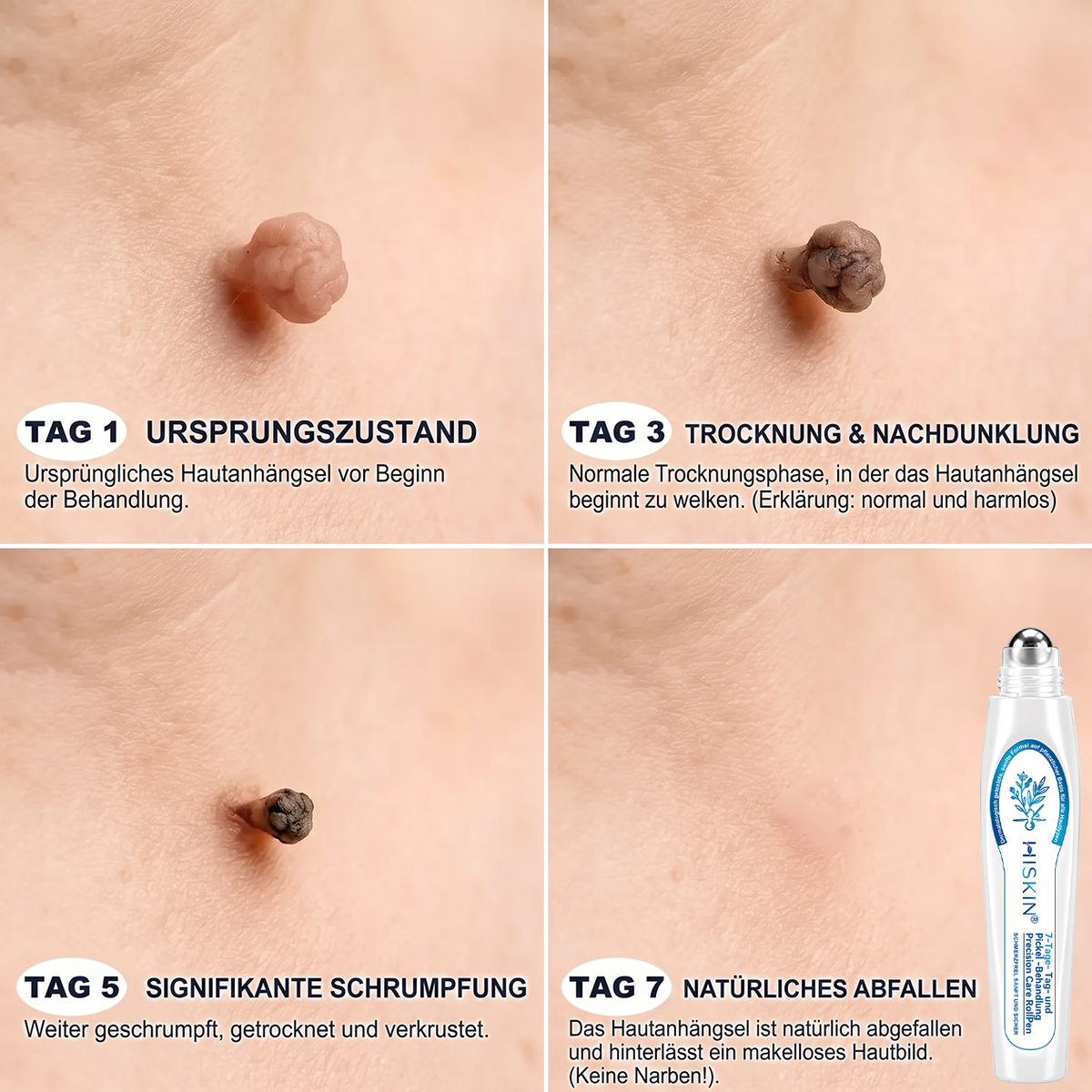 𝐇𝐈𝐒𝐊𝐈𝐍®👩‍⚕️⭐ 7-Tage-Hautmakel- & Hautanhängsel-Entferner Schmerzfreier Rollerball-Stift zur schonenden Entfernung von Hautanhängseln und Hautflecken – narbenfrei💚
